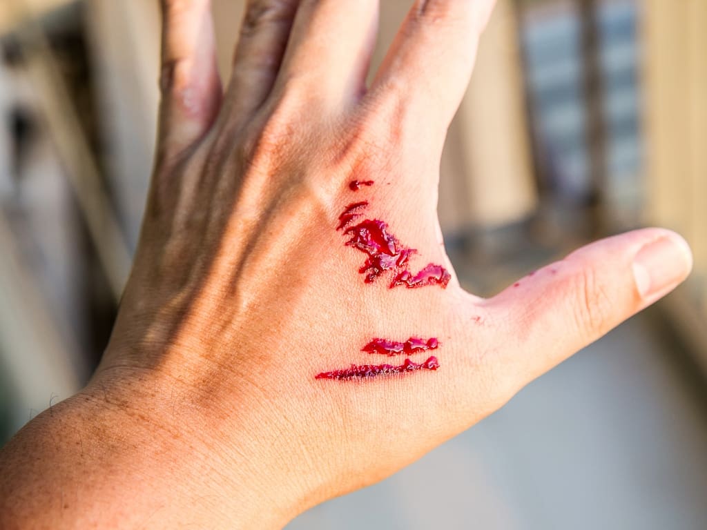 bitten hand