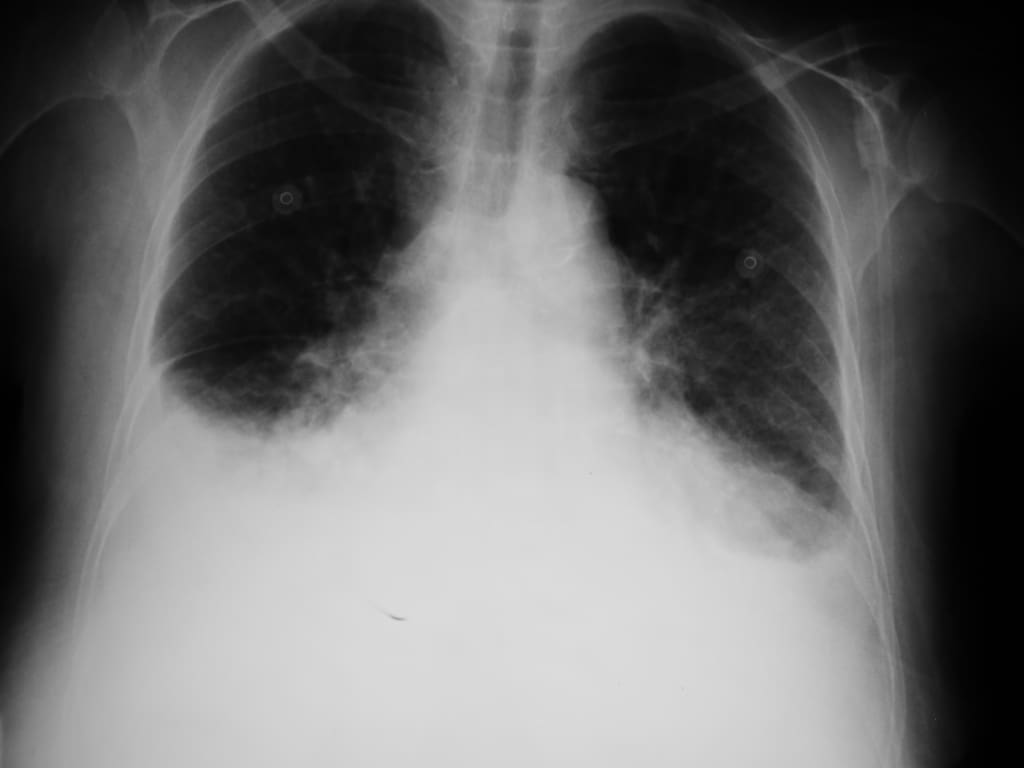 pulmonary edema