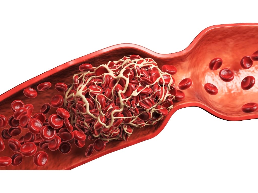 blood clot